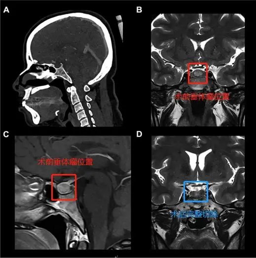37岁女性蝶鞍中央垂体瘤，神经内镜单鼻孔完整切除