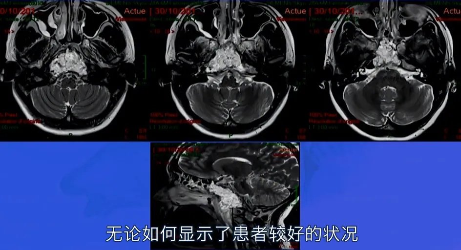 这是用脂肪填补空腔后的术后MRI