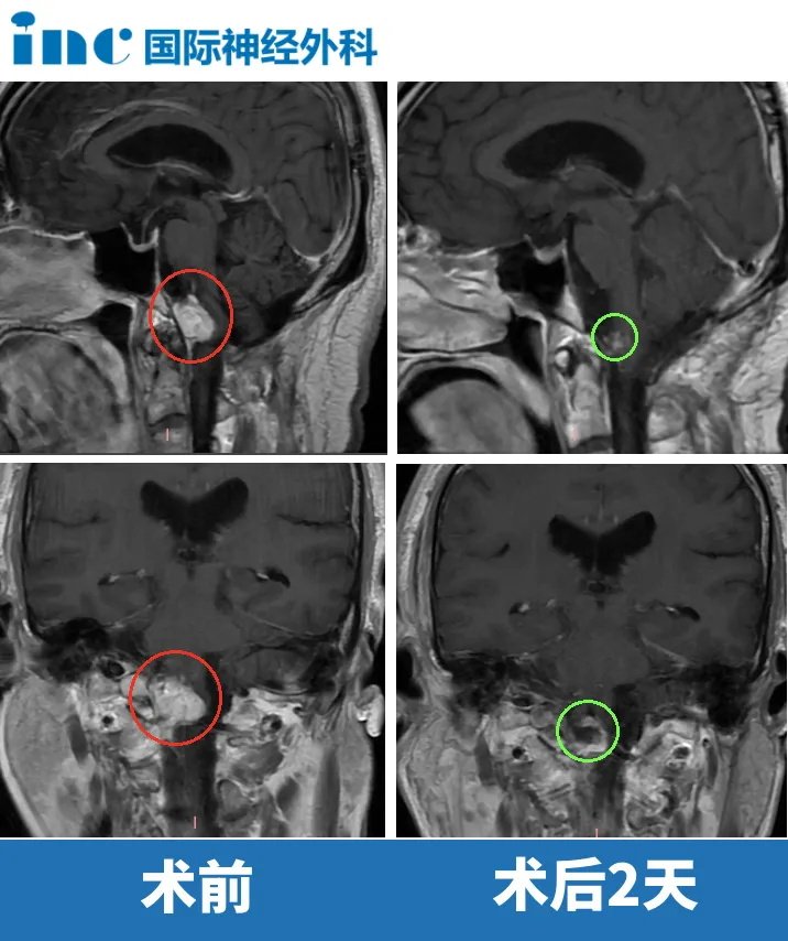 枕骨大孔区脑膜瘤影像