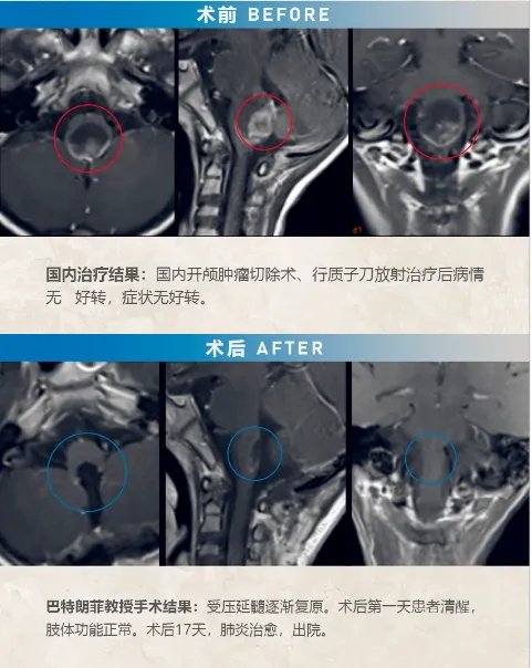 室管膜瘤复发之后怎么办？再次手术还有意义吗？