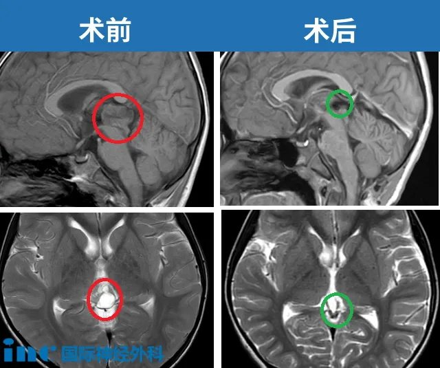 巴教授成功为鑫鑫示范手术