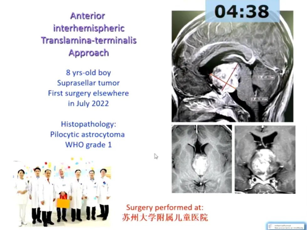 8岁男孩-视神经毛细胞星形细胞瘤