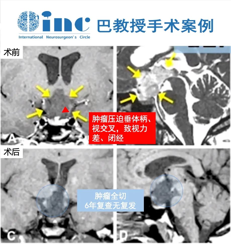 32岁女性-视路下丘脑胶质瘤