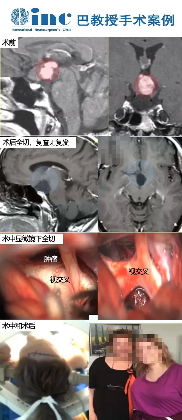 24岁女性-下丘脑视神经胶质瘤