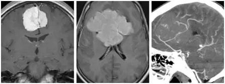 图2.不同体积的镰旁脑膜瘤。CTA显示胼周动脉及胼缘动脉被体积巨大的肿瘤包绕。