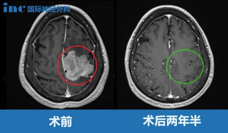 退休女士巨大脑膜瘤长在大静脉窦、大脑镰旁能手术吗？