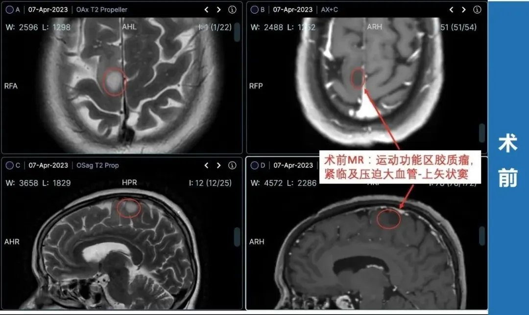 功能区胶质瘤术后功能能保留吗？