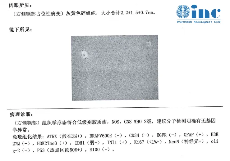 手术后病理结果为低级别胶质瘤。