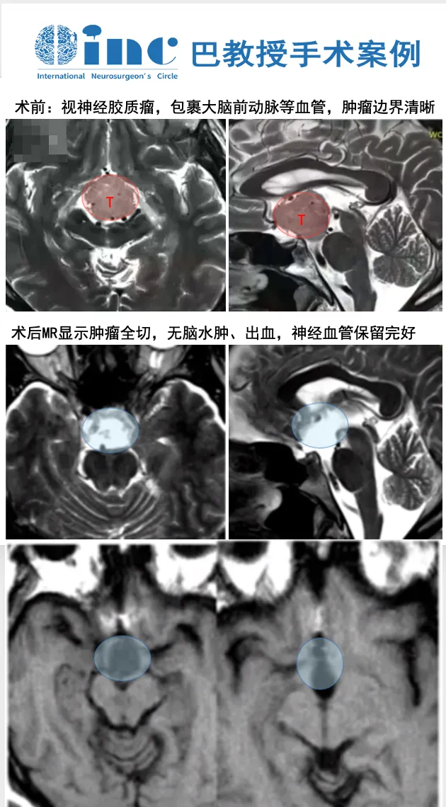 50岁男性-视神经下丘脑胶质瘤