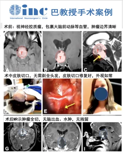 视神经下丘脑胶质瘤