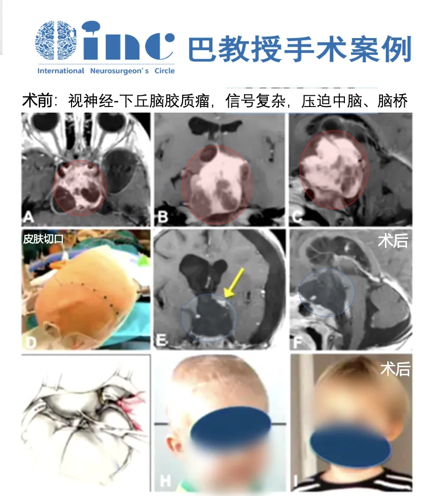 视神经下丘脑胶质瘤