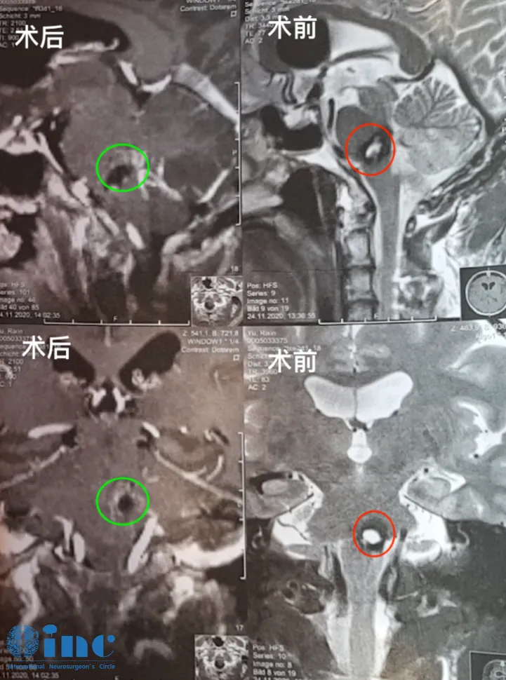 6次反复脑干出血，远渡重洋的他如何对抗脑干海绵状血管瘤？