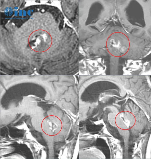 孩子脑干及第四脑室肿瘤脑积水