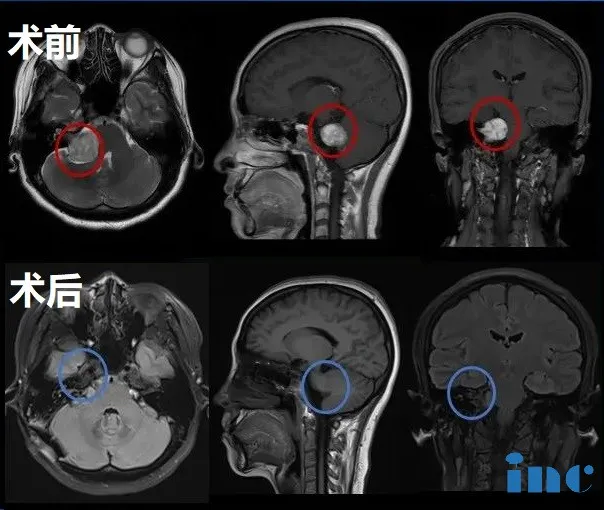 听神经瘤治疗成功案例