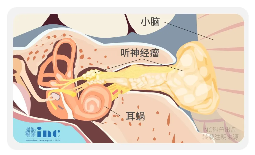 听神经瘤治疗