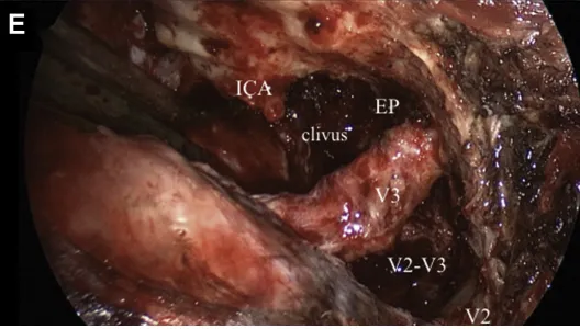 图E：显露颞下窝，大部分肿瘤已在镜下切除，暴露上颌神经(V2)和下颌神经(V3)，暴露岩骨菱形区和翼管。