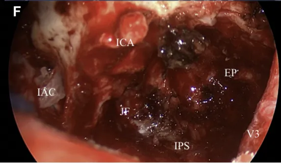 图F：神经内镜辅助下，可以观察到下颌神经（V3）和颈静脉孔内侧下方。改善了岩尖三叉神经下方、海绵窦下壁及中、下斜坡区域的操作视野。