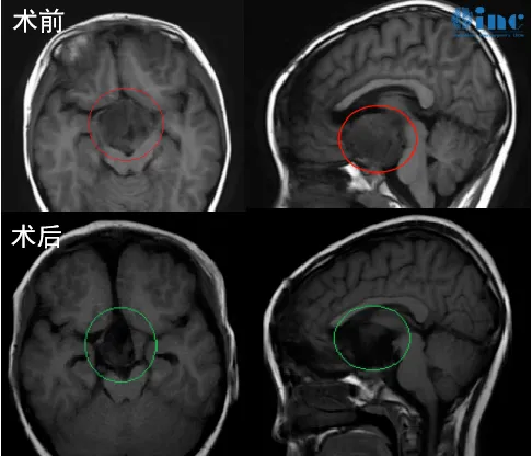 6岁男孩视神经-毛细胞星形细胞瘤