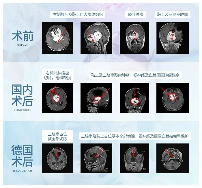 手术后复诊终于看清了巴爷爷的样子