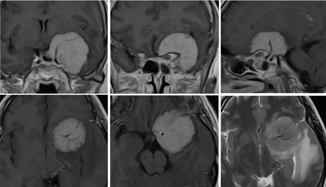 前床突脑膜瘤诊断