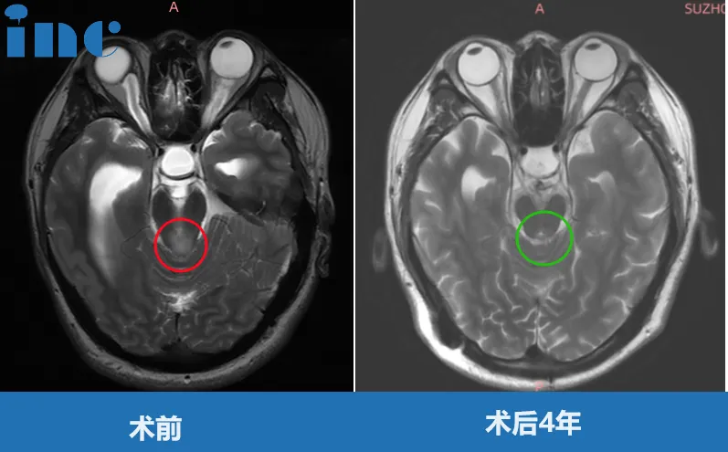 20岁男性中脑-顶盖胶质瘤