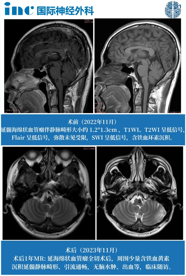 脑干海绵状血管瘤伽马刀治疗有效吗？