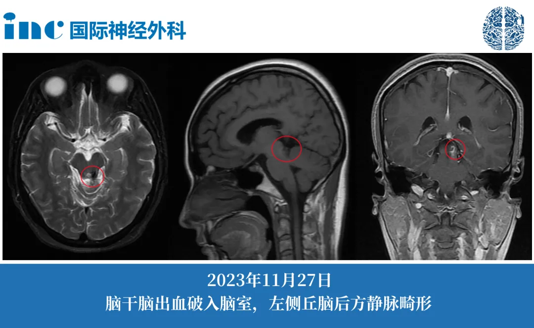 海绵状血管瘤？静脉畸形？毛细血管扩张？