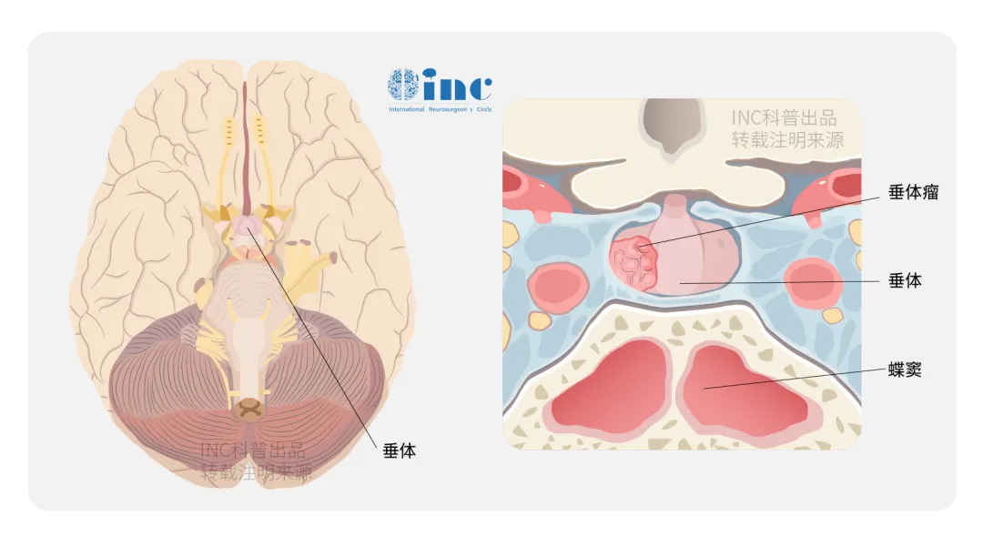 垂体腺瘤（俗称垂体瘤）