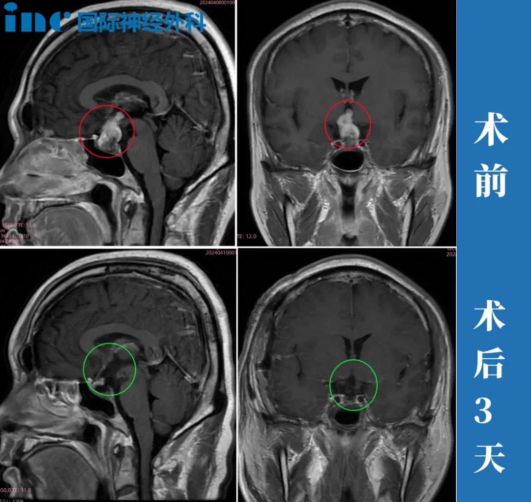 ⼿术后是否需要其他辅助治疗⼿段？现在研究的颅咽管瘤靶向药是否可以⽤于辅助治疗？