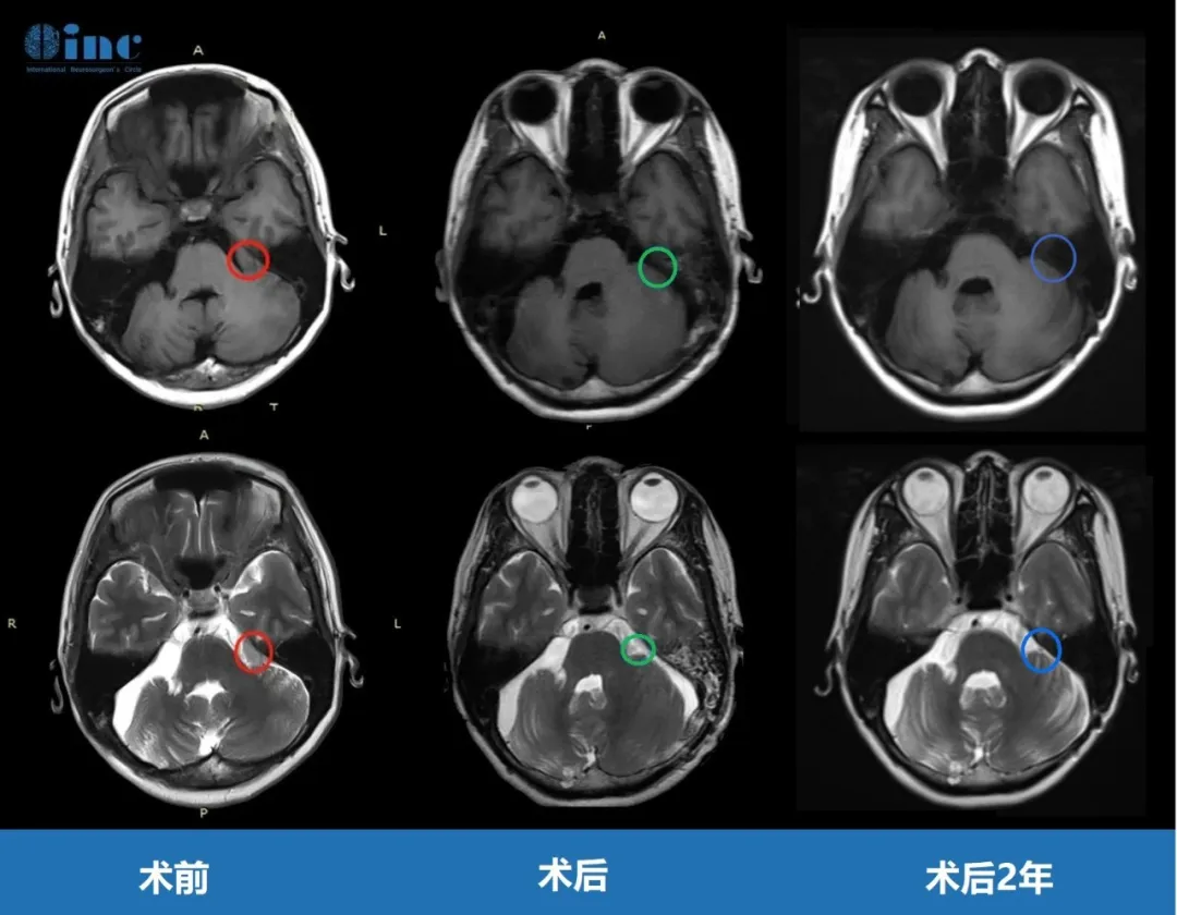 术后2年，孟女士怎么样了？