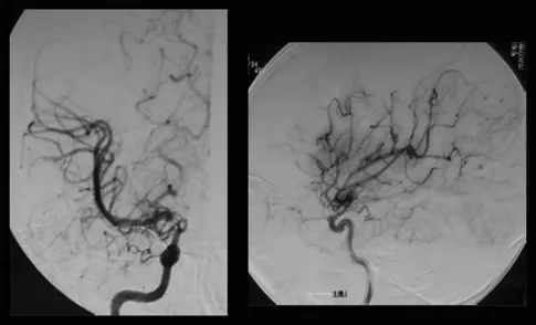 图1：术前右颈血管造影显示，在颈内动脉末端顶部，血管烟雾弥漫性发育，大脑中动脉扩张