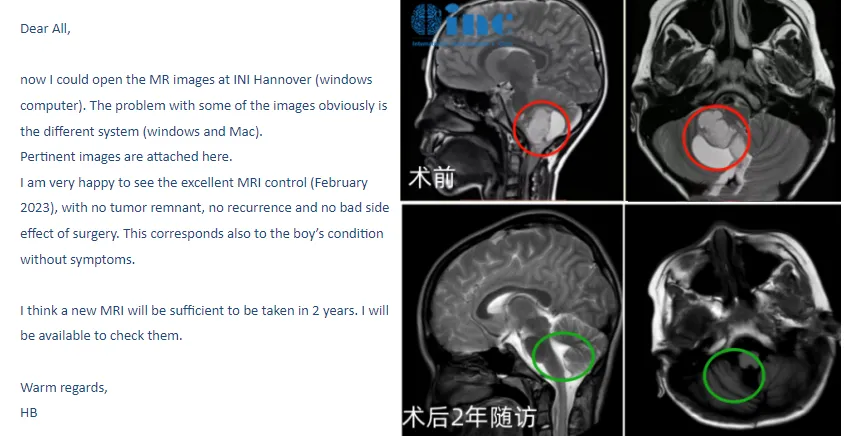 7岁男孩巨大小脑-脑干胶质瘤赴德术后2年半随访