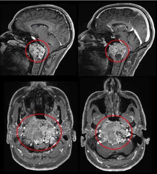 术前MRI