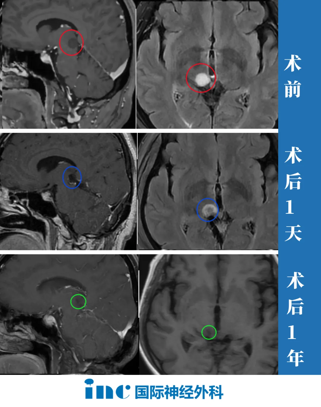 52岁女士丘脑胶质瘤成功手术