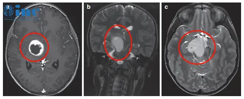9岁男孩丘脑胶质瘤，手术+化疗效果良好
