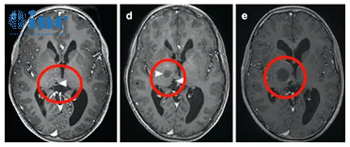 3岁男孩巨大丘脑胶质瘤，手术+化疗效果良好