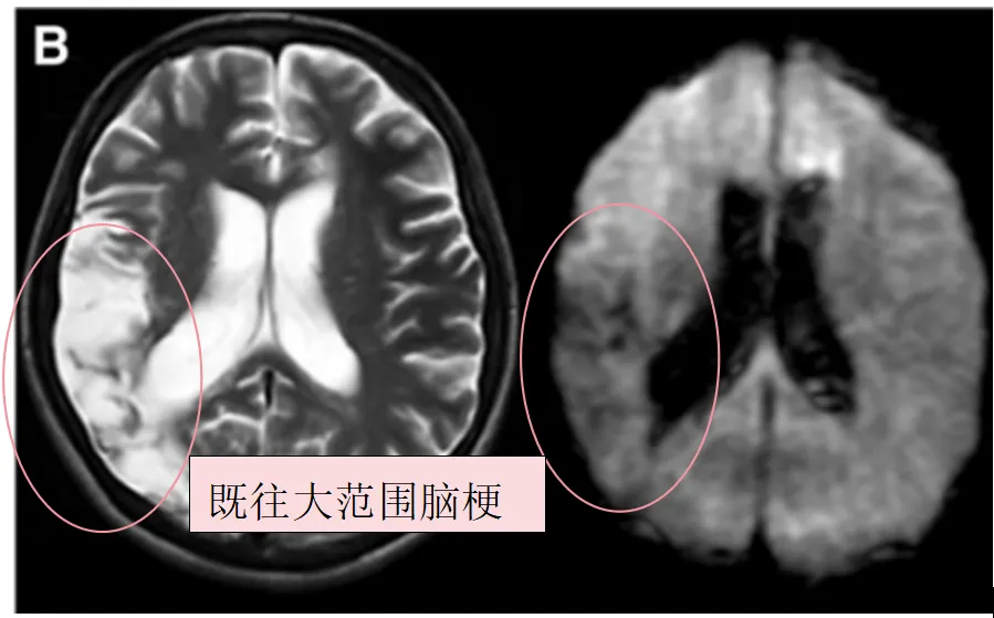 图1B：术前T2、DWI序列显示入院前1个月显示，既往右侧额顶叶脑梗死