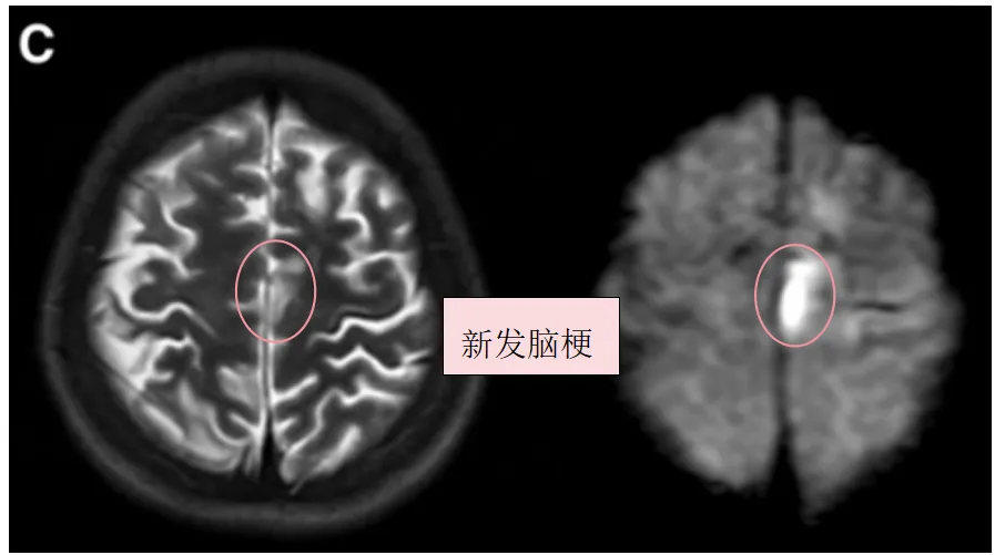 图1C：术前T2、DWI序列显示左额叶新发展的脑梗死