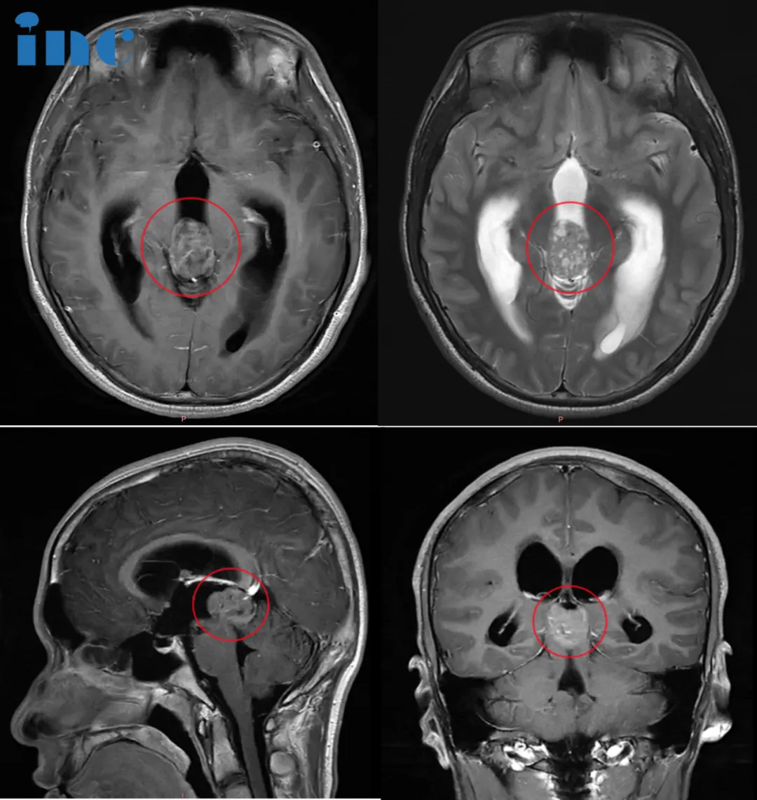 CASE 2：16岁男孩-松果体肿瘤