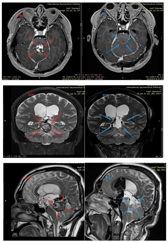 CASE 4：40岁女士-松果体肿瘤