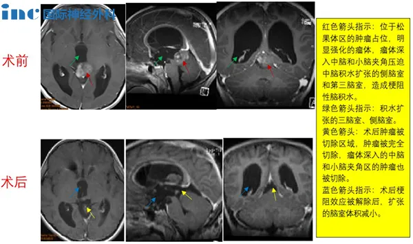 CASE 5：8岁男孩-松果体肿瘤
