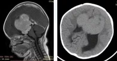 一岁小朋友巨大视神经胶质瘤