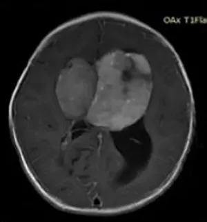 一岁小朋友巨大视神经胶质瘤