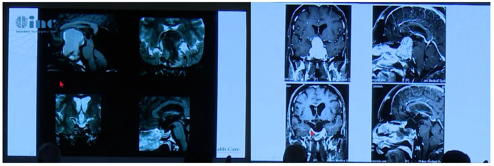 Couldwell教授演讲中展示的部分巨大垂体瘤