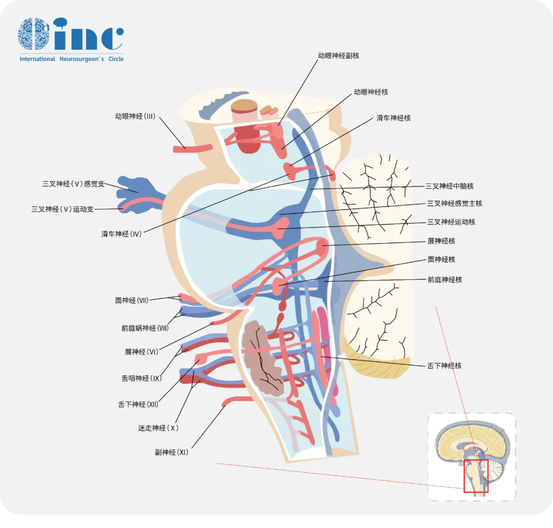 “手术禁区”——脑干为什么那么难？