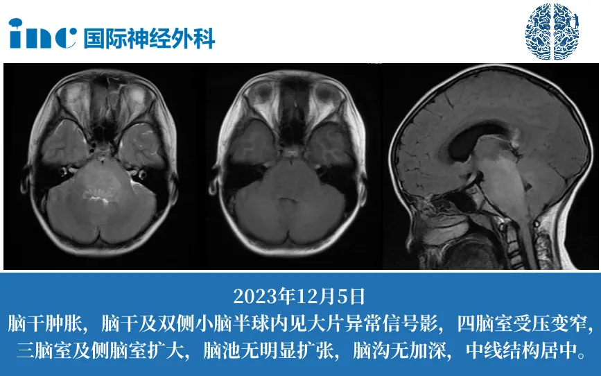 Rutka教授咨询案例：9岁女孩脑干弥漫高级别胶质瘤