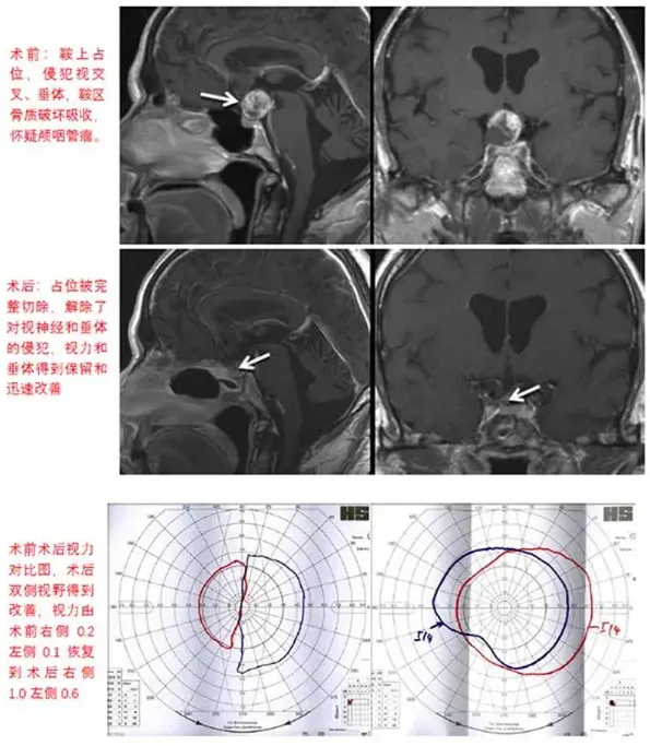 Henry W.S.Schroeder教授手术案例