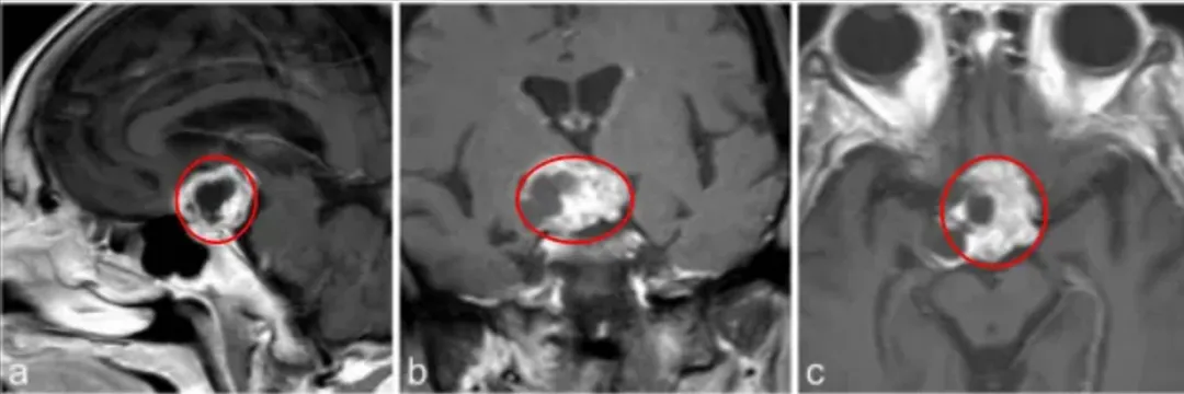 a–c图中，MR成像显示鞍上部分实性，部分囊性对比增强病变，高度可疑的颅咽管瘤。