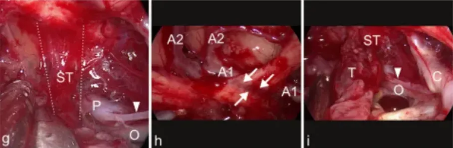 g图表示背侧肿瘤表面，垂体柄浸润（ST，在虚线）被可视化处理眼动脉（O），后交通动脉P1段（P）和后交通动脉（箭头）。h图表示肿瘤切除后，左视神经内出现严重的压迹（箭头），由于肿瘤对神经的压迫和A1区段引起的可以看到大脑前动脉（A1和A2）。i图中，最终检查显示垂体后叶浸润（ST）后部、交通动脉（箭头）、岩上段颈内动脉（C）和动眼神经（O）的肿瘤残留（T）