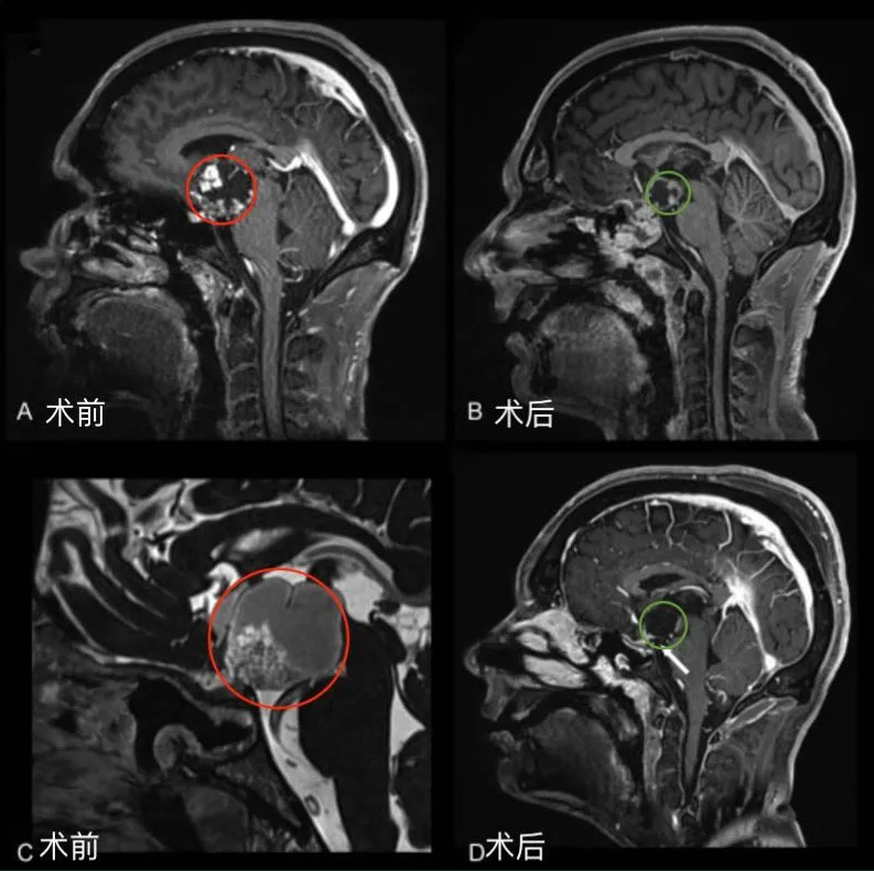 图1后视交叉性巨大颅咽管瘤患者肿瘤术前（A，C）和术后（B,D）矢状位增强MR对比，显示肿瘤全切。